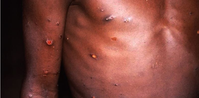 ‘मंकीपक्स संक्रमितको संख्या ७० हजारभन्दा बढी पुग्यो’