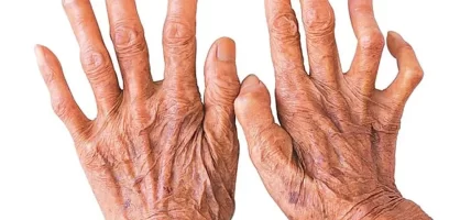 कुष्ठरोग नियन्त्रण एवं जीवनस्तर सुधार सम्झौता