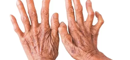 बाँके कुष्ठरोगको उच्च जोखिममा