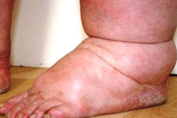 हात्तीपाइलेविरुद्धको दशदिने औषधि सेवन अभियान