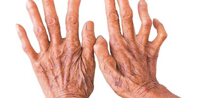 छ महिनाभित्र बाँकेमा ८६ नयाँ कुष्ठरोगी